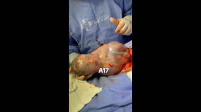 #medicina #saberespoder #momentosunicos #tokyvideos #nacimiento #aprender #compartiryseguir                          Como sale un Bebé de una placenta