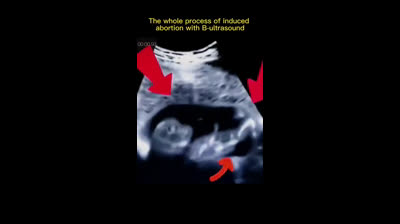 Miren cómo el bebé sabe que está en peligro y reacciona tratando de defenderse ante el peligro.